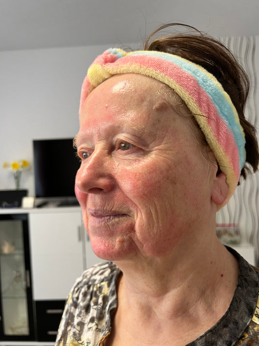 Microneedling in Düsseldorf: Die moderne Therapie gegen Altersflecken und Hautprobleme