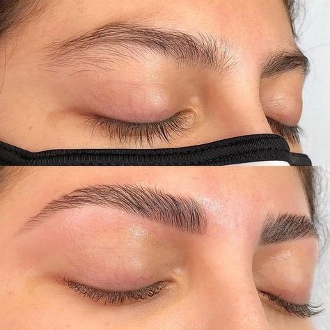 Brow Lifting